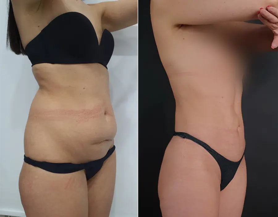 Елена Калино -  Плоский живот после родов или при диастазе за 8 недель