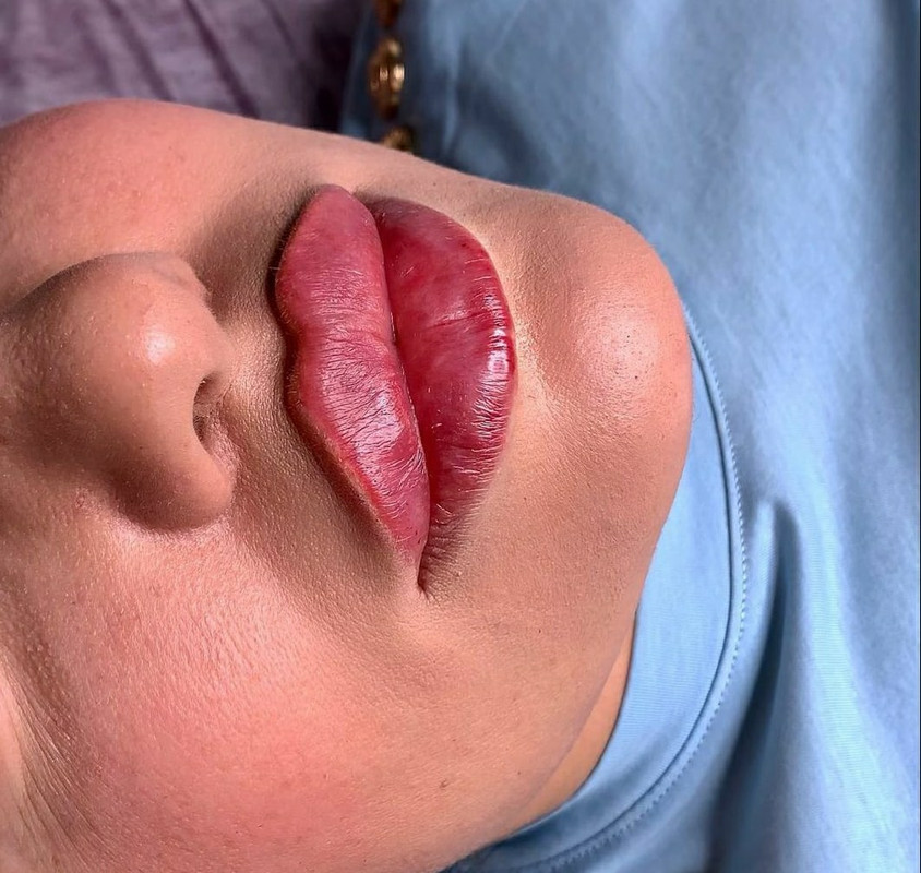 Аида Гарунова - Увеличение губ по технике методике Гаруновой